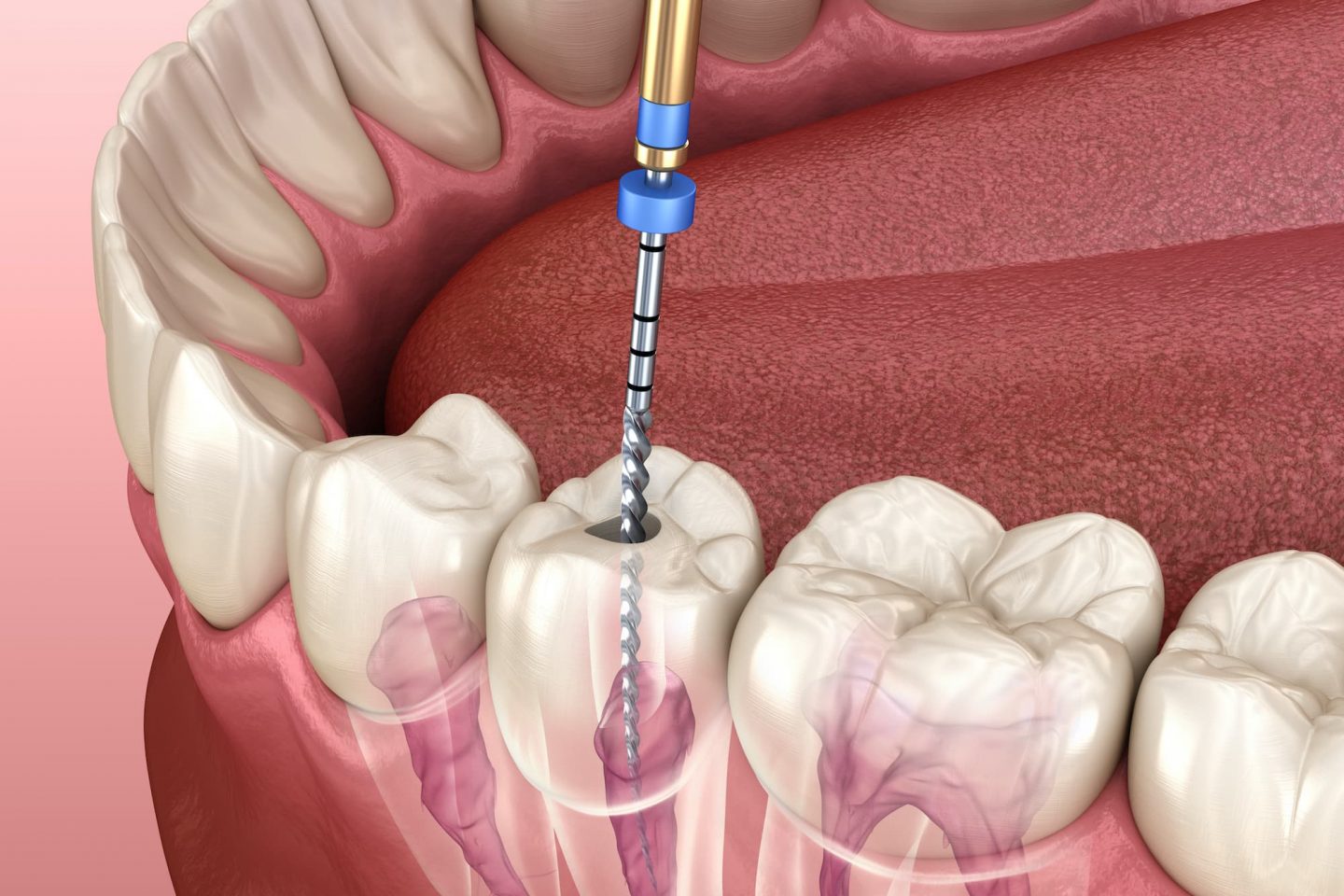 RCT(Root Canal Treatment)