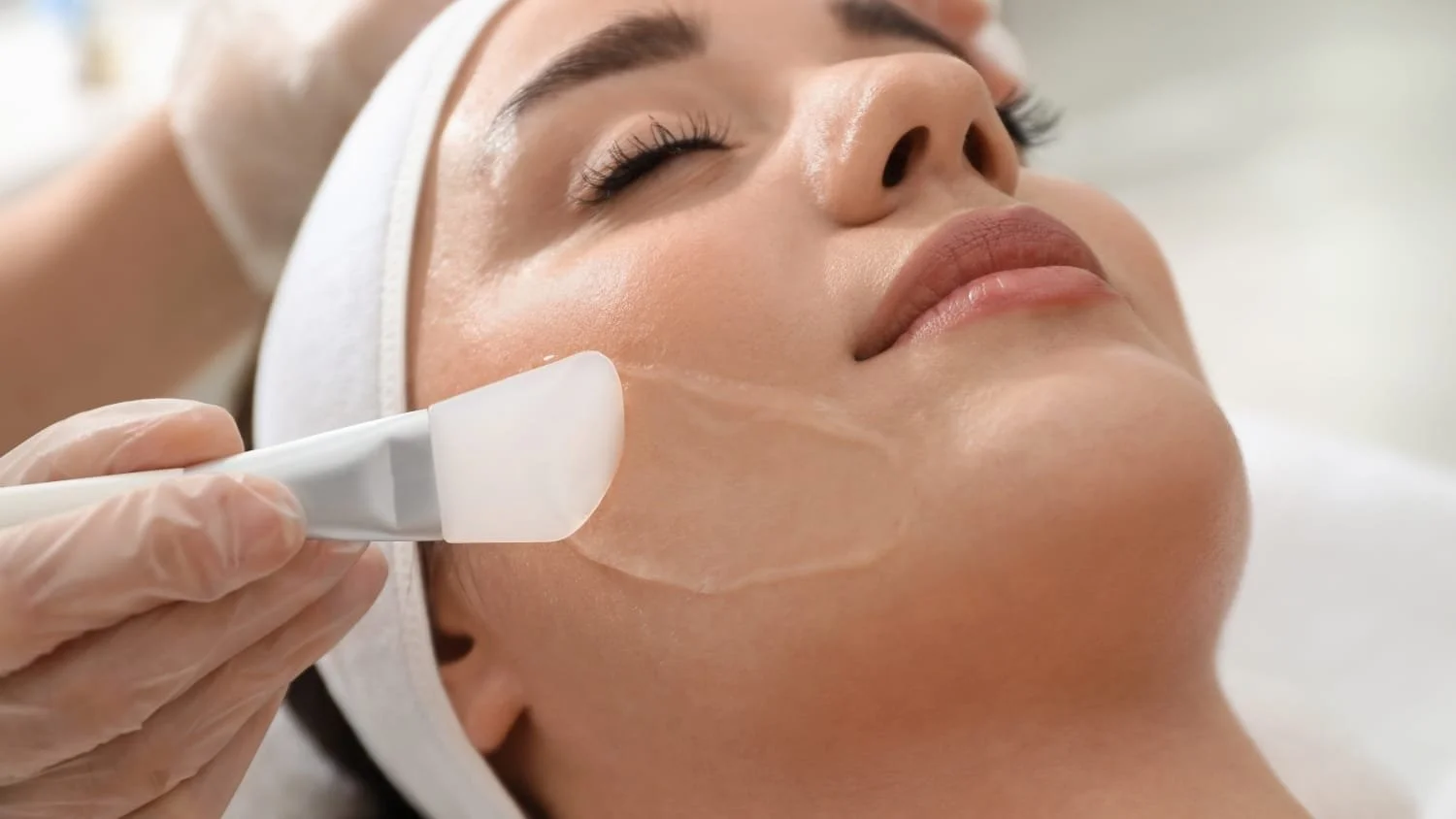 Chemical Peels
